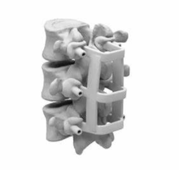 JZDB-01 3D打印脊柱手术导板