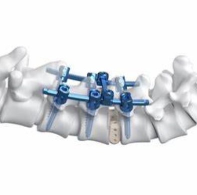胸腰椎后路钉棒内固定系统安颂科技