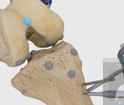 膝关节置换手术导航系统Surgical Navigation System