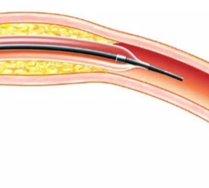 冠状动脉球囊扩张导管益心达