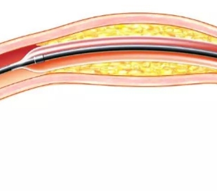 冠状动脉球囊扩张导管