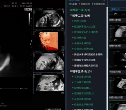 AiriScan T8产前动态超声影像处理系统爱孕记