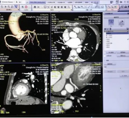 inferread cta coronary  ct造影图像血管狭窄辅助评估软件