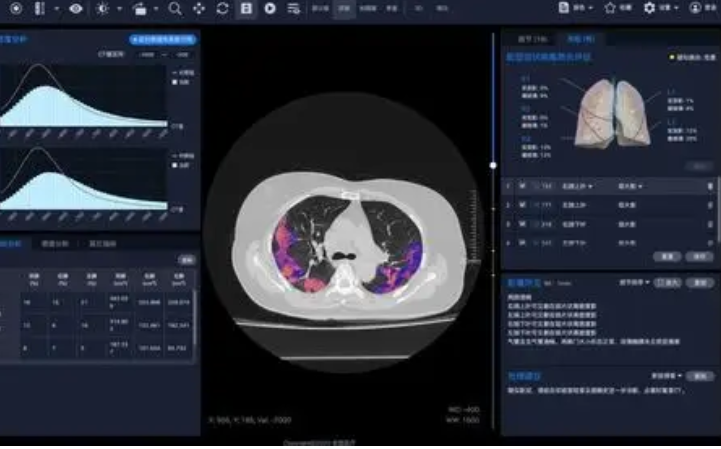 uAI-OncologyImaging 胸部CT影像处理软件