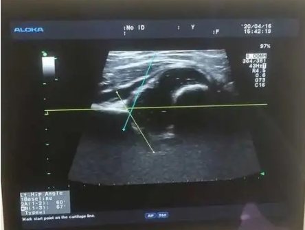 AutoDDH 婴幼儿髋关节超声影像处理软件