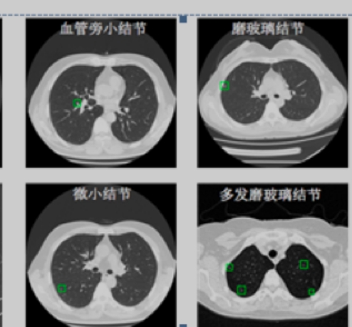 LungDoc 肺结节CT图像辅助检测软件语坤