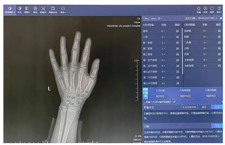 儿童手部X射线影像骨龄辅助评估软件