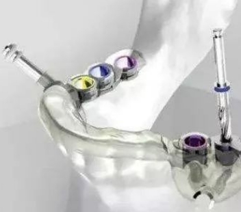 骨盆导板（JZ-D-GP） 医用个性化手术导板京准