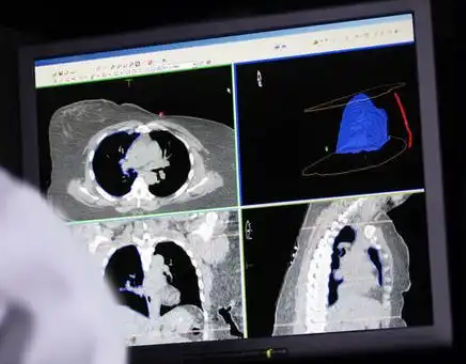 uAI–PulmonaryArteryImaging 肺动脉CT造影影像处理软件