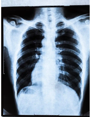InferRead CT Fracture 胸部骨折CT图像辅助分诊软件