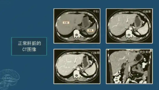 XMQB-Liver V2.0 肝脏影像处理软件