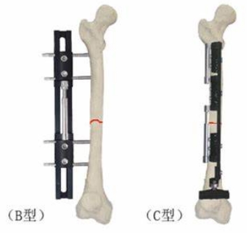WGD-XZ Ⅱ型 四肢外固定装置布拉德