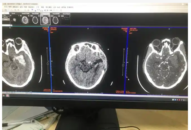InferRead CT Stroke 颅内出血CT图像辅助分诊软件