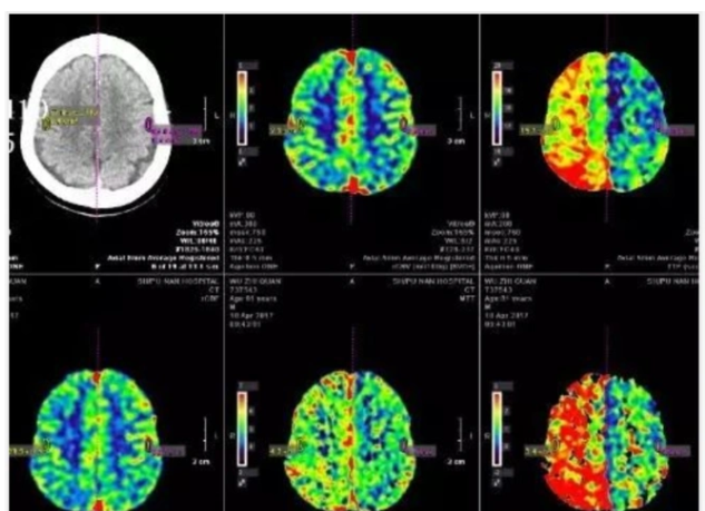uAI–CerebralPerfusion 脑灌注CT影像处理软件