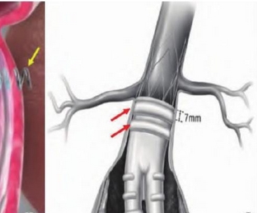 华脉泰科腹主动脉覆膜支架系统