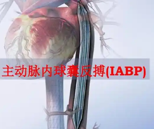 主动脉内球囊反搏泵(iabp)
