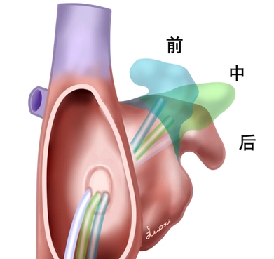 房间隔穿刺系统