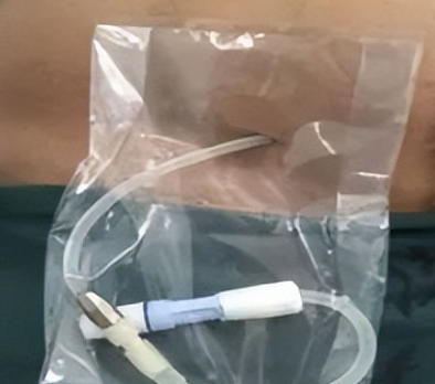 YW-2065视频腹膜透析置管镜询价