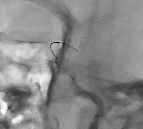 KCM5020 颅内取栓支架价格区间
