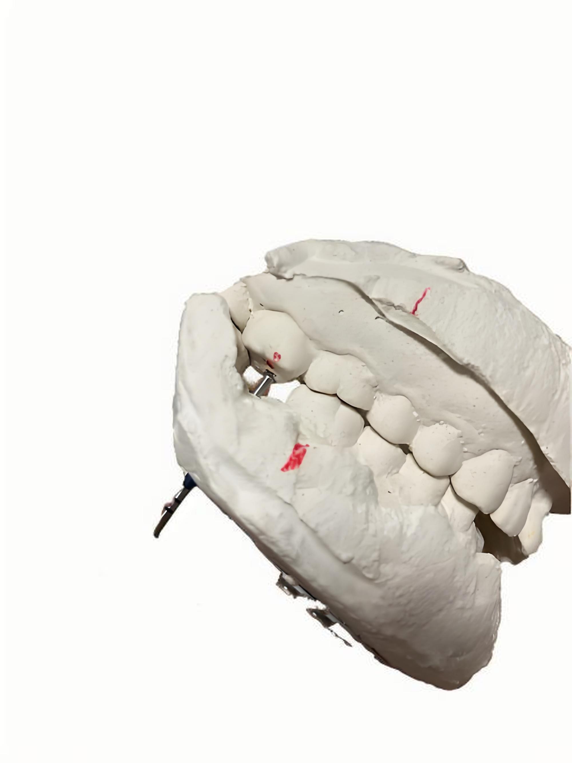 定制式牙科种植用导板供应商