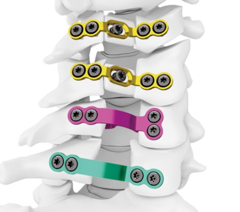 椎板固定板系统采购价