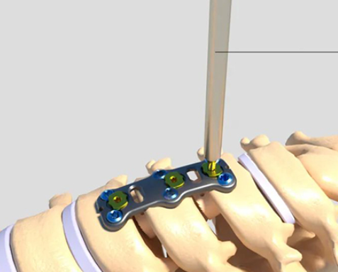 颈椎前路钉板固定系统厂家销售价