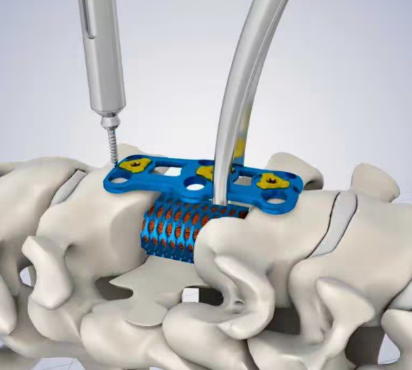 颈椎前路钉板固定系统平台