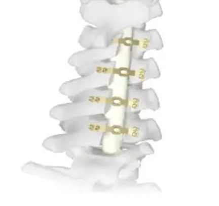 椎板固定板系统代理