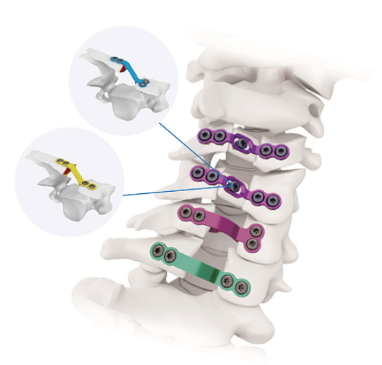 椎板固定板系统厂家直销