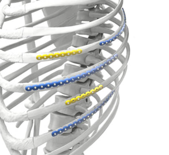 肋骨接骨板代理