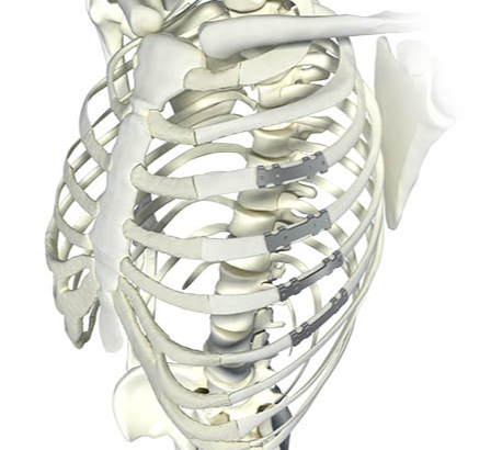 肋骨接骨板厂家直销