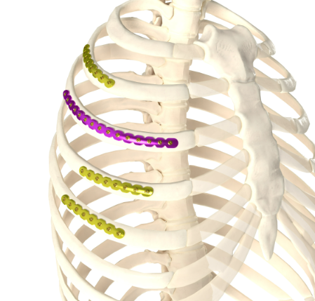 肋骨接骨板平台