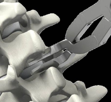 棘突间固定系统总代理