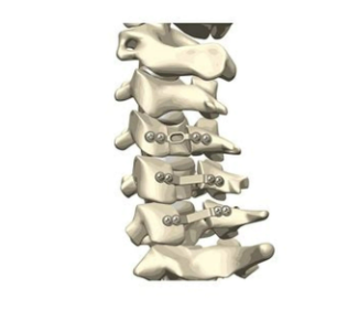 椎板固定板系统厂家直销