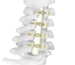 椎板固定板系统平台