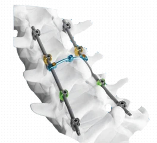 脊柱后路内固定系统 厂家