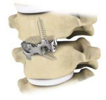 钛涂层自稳型颈椎前路椎间融合固定系统零售价