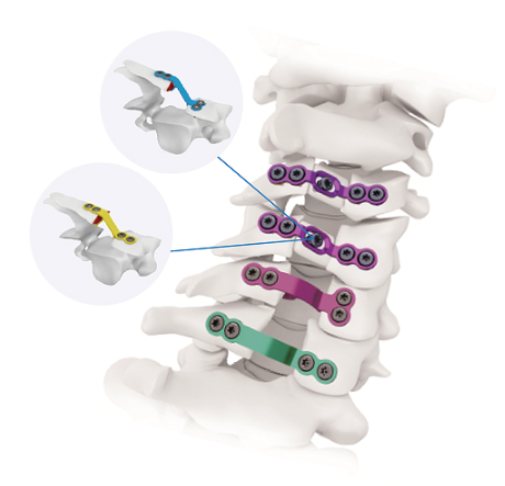 枕颈胸后路内固定系统哪个品牌好？