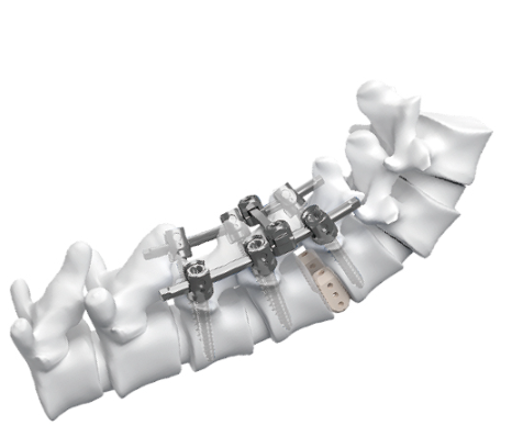 枕颈胸后路内固定系统批发价