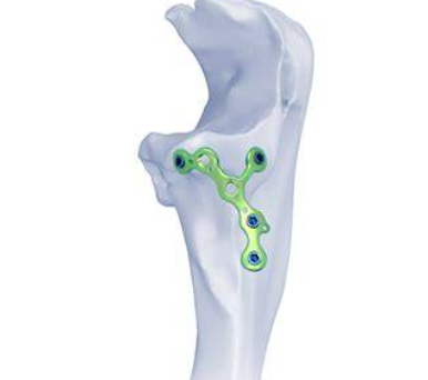 手足锁定接骨板系统哪个品牌好？