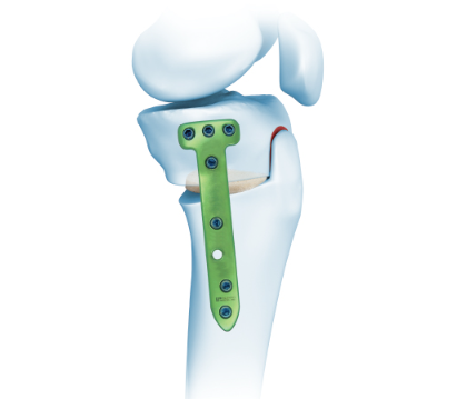 手足锁定接骨板系统批发价