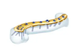 手足锁定接骨板系统直销价