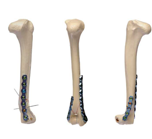 钛合金手足锁定接骨板系统厂家销售价