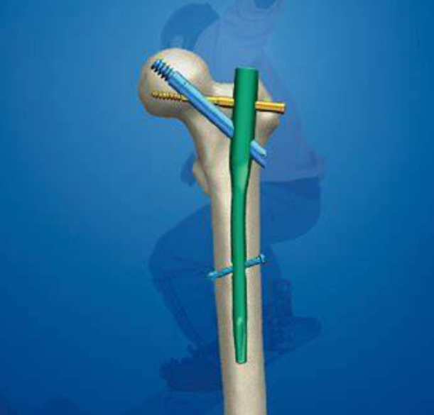 股骨近端角度钉板系统厂家直销