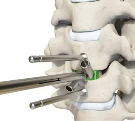 自稳定型颈椎融合器总代理