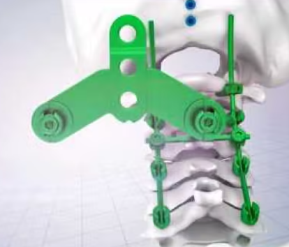 颈椎后路内固定系统供应商