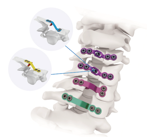 颈椎后路内固定系统代理