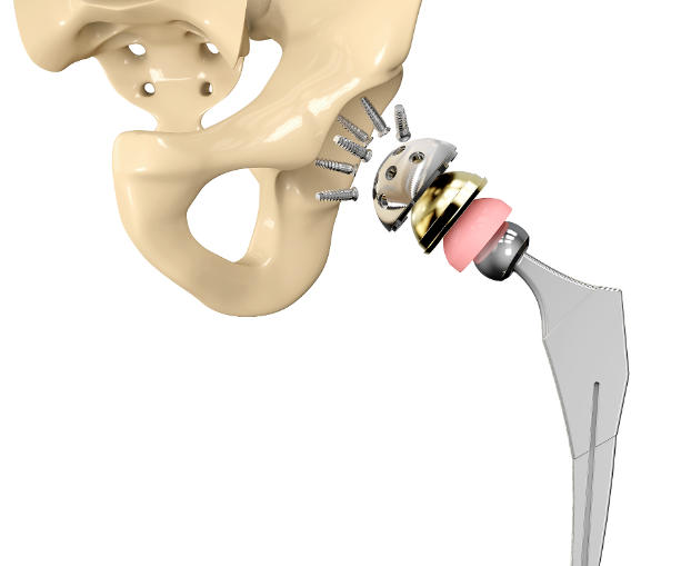 ROPAplasty-01 髋关节置换手术导航定位系统 厂家