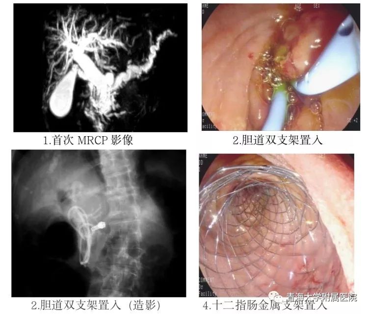 bd医疗怎么样超声内镜引导下胆汁引流术（EUS-BD）——开启青海大学附属医院内镜微创治疗新天地