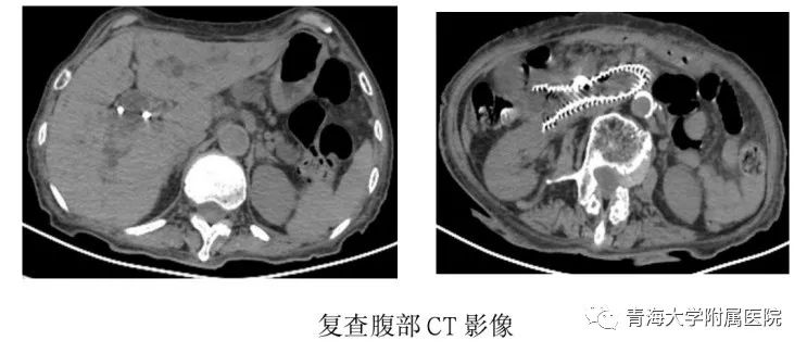 bd医疗怎么样超声内镜引导下胆汁引流术（EUS-BD）——开启青海大学附属医院内镜微创治疗新天地